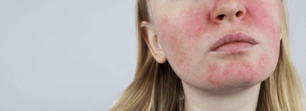 הקשר בין מצבים פסיכיאטריים וורדת (ROSACEA) דוקטור אביגדור סרברניק
